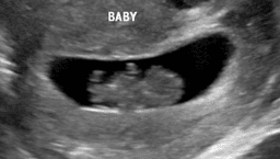 Image for 6-9.5wks Early Peek Reassurance Scan