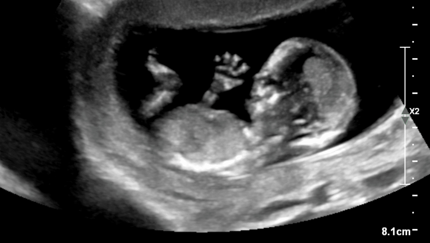 Image for 15-24wks Gender Confirmation ONLY