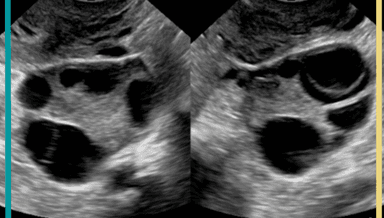 Image for Follicular (Pelvic) Ultrasound, CPT 76857
