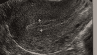 Image for Pelvic/Transvaginal Complete: CPTs 76856 & 76830