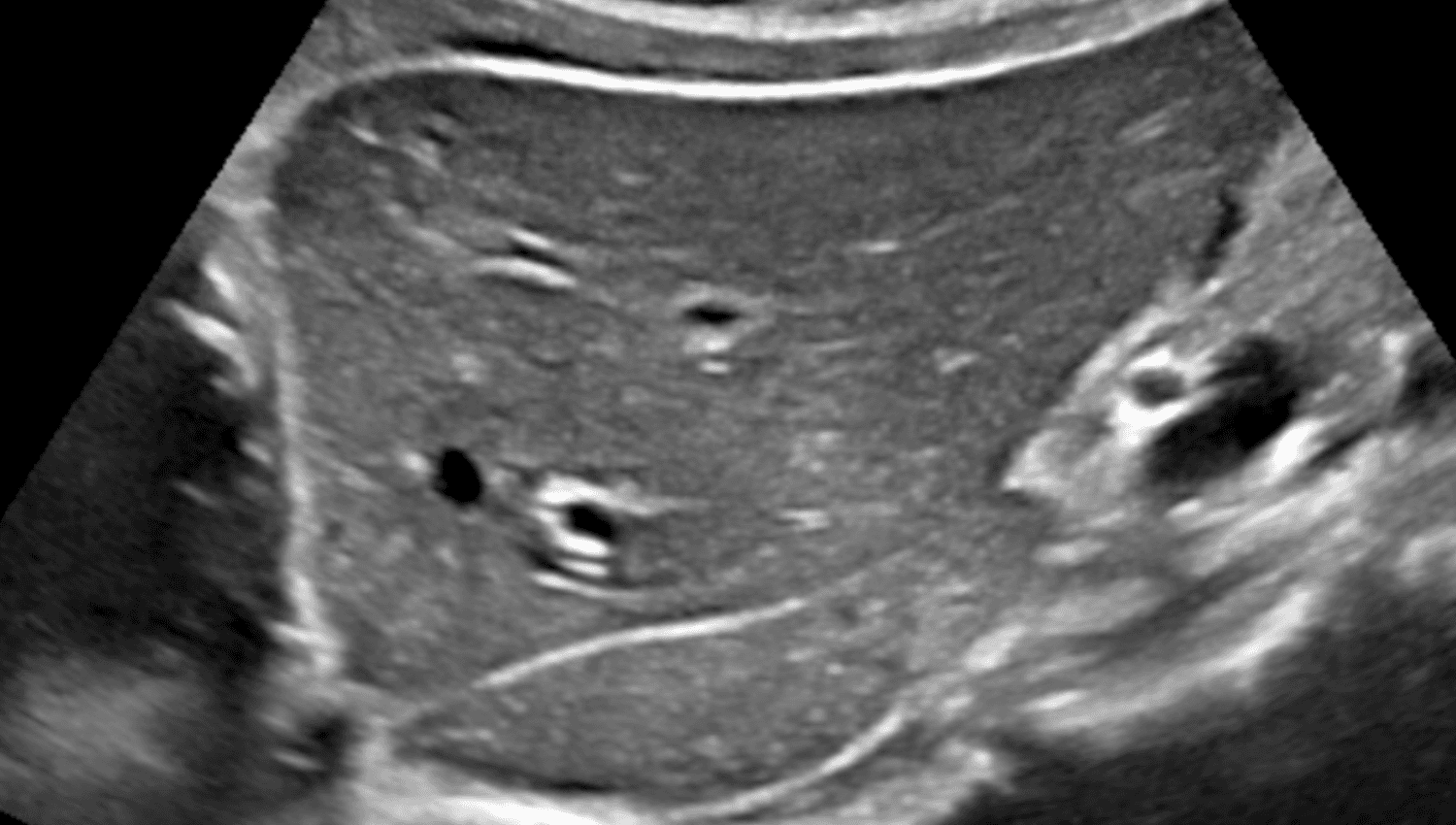 Image for RUQ- Right Upper Quadrant, CPT 76705